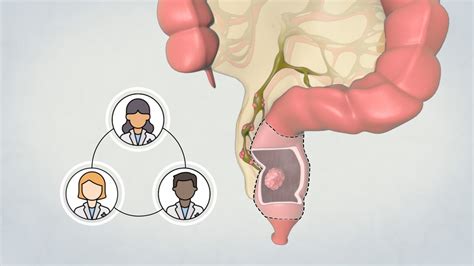 Patient Teaching Low Anterior Resection Surgical Management Of