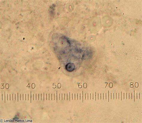 Trofozoítos De Entamoeba Histolytica E Dispar Fotografias Microscópicas E Macroscópicas