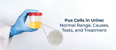 Pus Cells In Urine Normal Range Causes Tests And Treatment