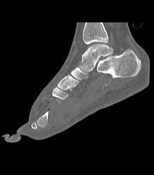 Nice Calcaneus With Mild Degenerative Joint Disease Djd With Foot