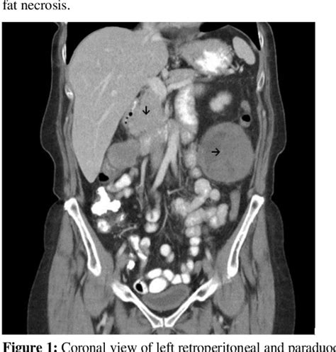 Figure 1 From A Rare Case Of Recurrent Phyllodes Tumor Of Bilateral