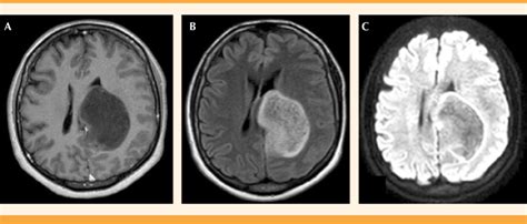 Resonancia magnética nuclear cerebral contrastada A T1 Lesión