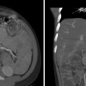 Multidetector Computed Tomography Axial A And Reformed Coronal B