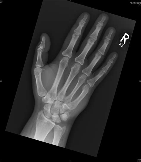 Hook of Hamate Fracture - Hand - Orthobullets