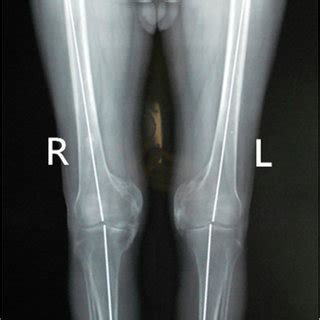 Preoperative Radiographs Of The Pelvis Shows Para Articular Ho On The