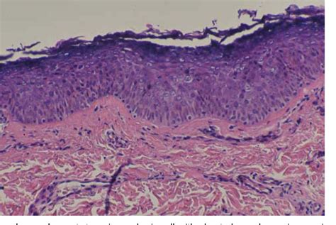 Figure From Acquired Epidermodysplasia Verruciformis In A Renal