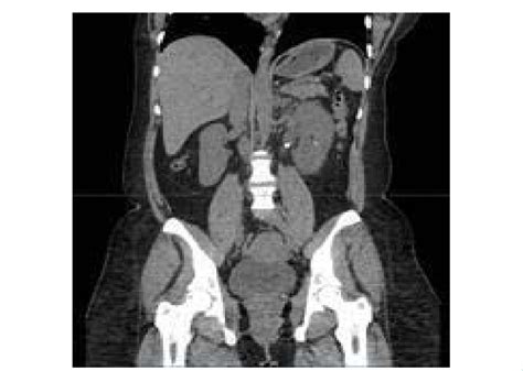 Ct Abdomen Without Contrast Showed Left Ureteropelvic Junction Calculi Download Scientific