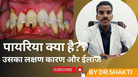 पयरय कय ह इसक करण लकषण और ईलज Periodontitis cause