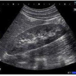 Ultrasound Image corrupted by speckle noise. | Download Scientific Diagram