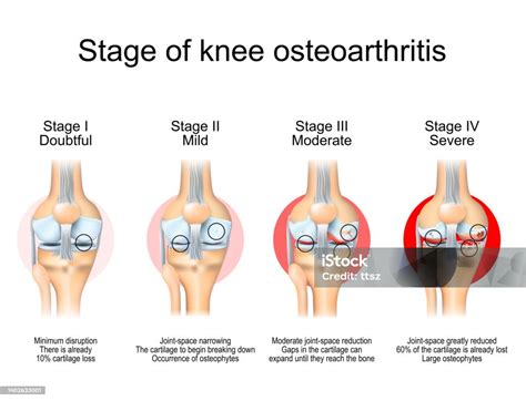 Stages Of Knee Osteoarthritis Stock Illustration Download Image Now