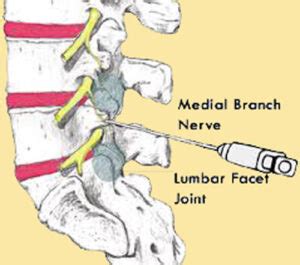 Medial Branch Block Ispine