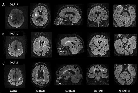 Individual representative 1.5 Tesla-brain MRI of patients with ...