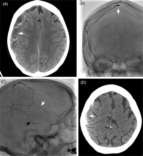 Middle Meningeal Artery Embolization To Treat Chronic Subdural Hematoma