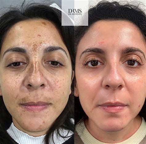 Cosmelan De Pigmentation Peel Dr Medispa Award Winning Clinics