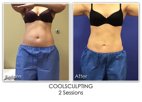 Coolsculpting Pro Archives Page 2 Of 3 Skin Rejuvenation Clinic