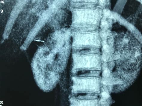 Vietnamese Medic Ultrasound Case Gastric Perforation Due To