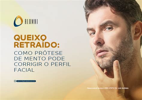 Queixo retraído Como prótese de mento pode corrigir o perfil facial