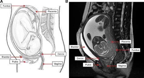 (A) Normal gravid uterus. (B) MRI of the first patient. The image shows... | Download Scientific ...