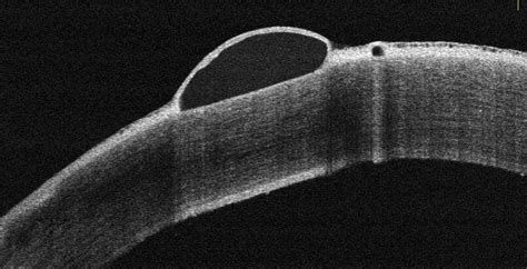 Tomographie en Cohérence Optique du segment antérieur montrant une