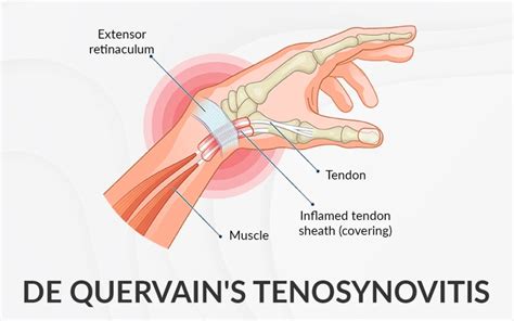 De Quervain’s Tenosynovitis Overview Physical Therapy Treatment And Exercise