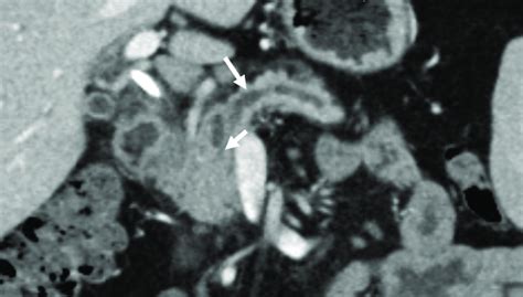 A 45 Year Old Male With Biliary Stent Placement For Obstructive