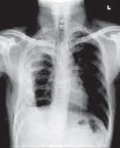 Cxr Showing Empyema Thoracis With Resultant Collapse Of The Lung And