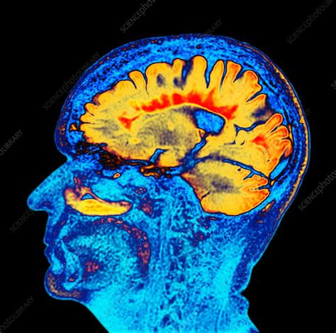 Multiple sclerosis, sagittal brain MRI scan - Stock Image C037/2389 ...