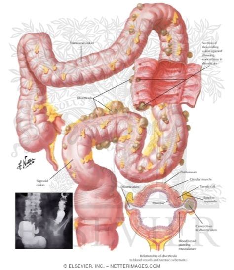 Diverticulosis