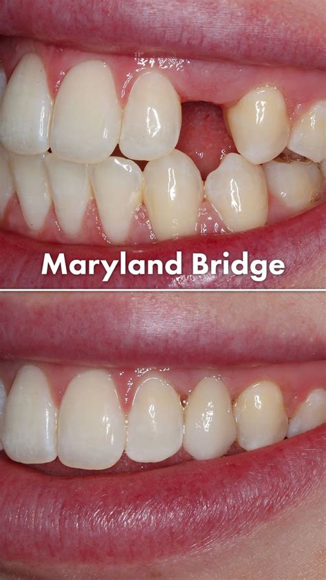 Maryland Bridge Case Tooth Bridge Dental Treatment Dental