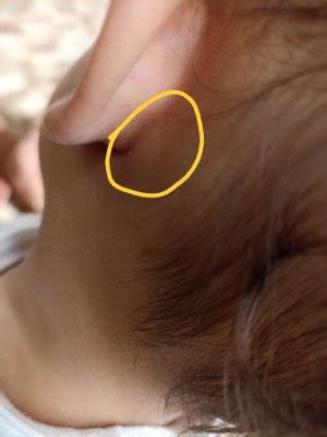 Mi bebé tiene una bolita detrás de la oreja BabyCenter