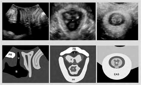 Transperineal Ultrasound Left Normal Three Compartment View Middle