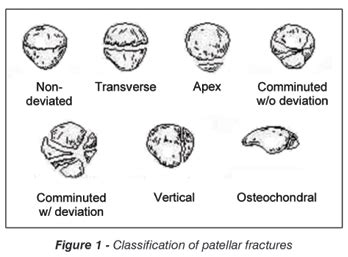 Patella Fracture - Trauma - Orthobullets