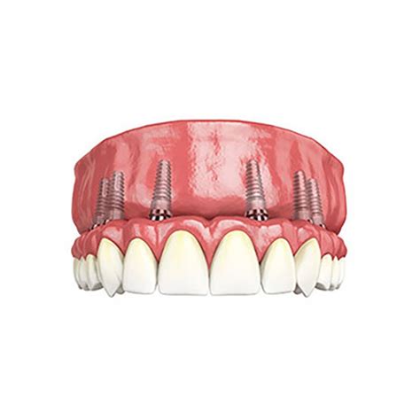 Dentures vs Implants Which Is The Better Option? - IMPLANT PERIO CENTER