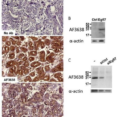 Egfl Is Expressed By Cancer Cells In Breast Tumor Sections Human