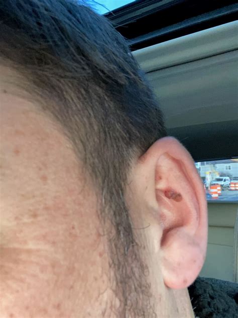 Cancer Behind Ear