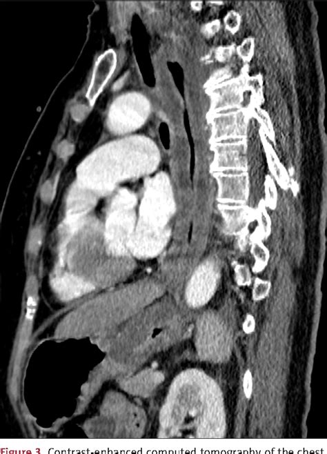 tonsil abscess | Semantic Scholar