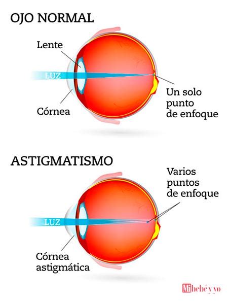 Apuntes De Un Maestro De Escuela Astigmatismo Mi Pico