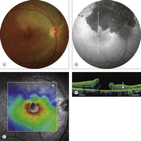 Macular Hole | Clinical Gate