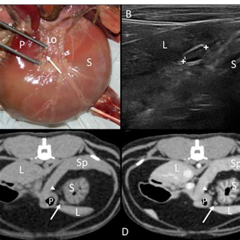 Splenic Lymph Node A Image Of The Dissection Showing Its Localization