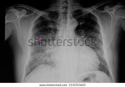 Chest Xray Film Patient Cardiomegaly Congestive Stock Photo 1132353623