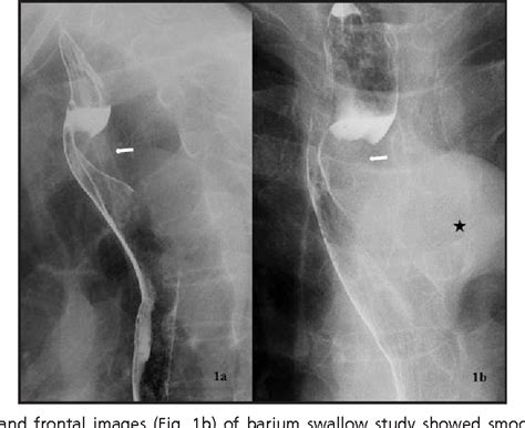 Figure 1 From Dysphagia Lusoria A Rare Cause Of Prolonged Dysphagia