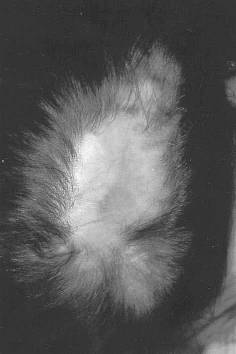 Scalp Aplasia Cutis Congenita Presenting With Sagittal Sinus Hemorrhage