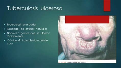 Tuberculosis Cutanea Ppt