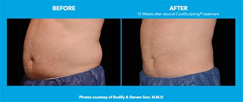 coolsculpting near me nj - Elane Sneed