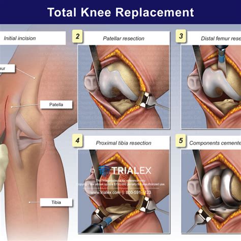 Bony Landmarks Of The Knee Trial Exhibits Inc