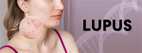 Lupus Symptoms And Treatment