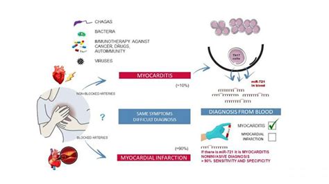 Miocarditis Sintomas Miocarditis Es El Nombre Dado A La Inflamación