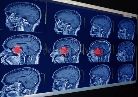 Resonancia Magn Tica Rm Del Cerebro Tumor Cerebral Absceso Cerebral