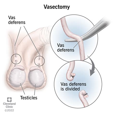 Vasectomy Procedure Recovery And Effectiveness