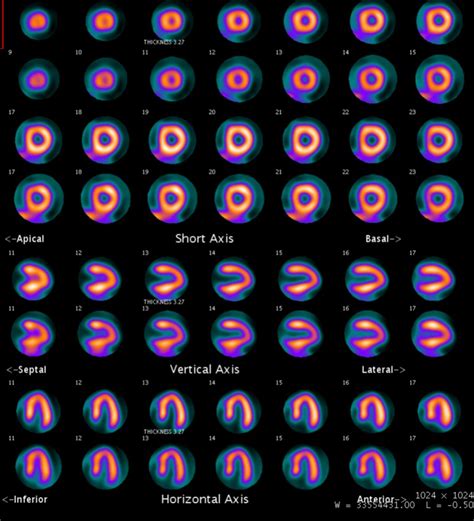 Diagnostic Accuracy Of N Ammonia Myocardial Perfusion Imaging With